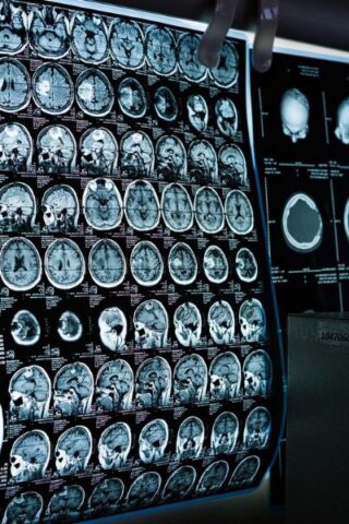 Un nuevo avance permitirá diagnosticar el Alzheimer mediante escáner